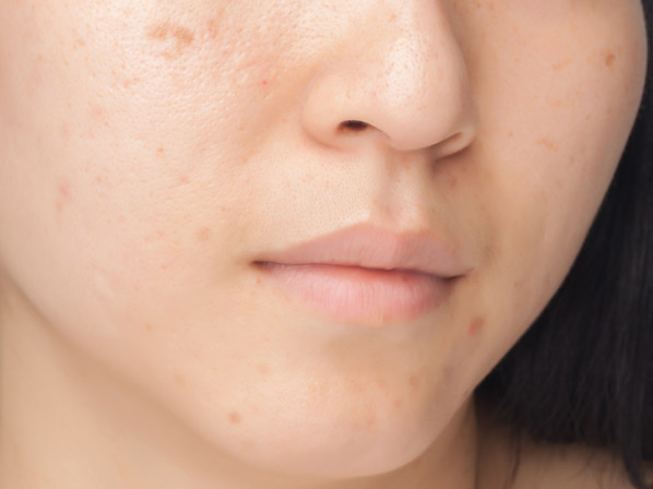 trucospara quitar manchas de la cara
