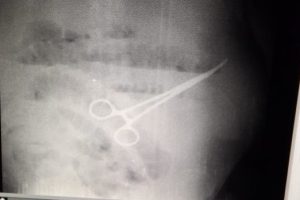 Un estudio de rayos x reveló que habían dejado una pinza quirurgica en el cuerpos del paciente